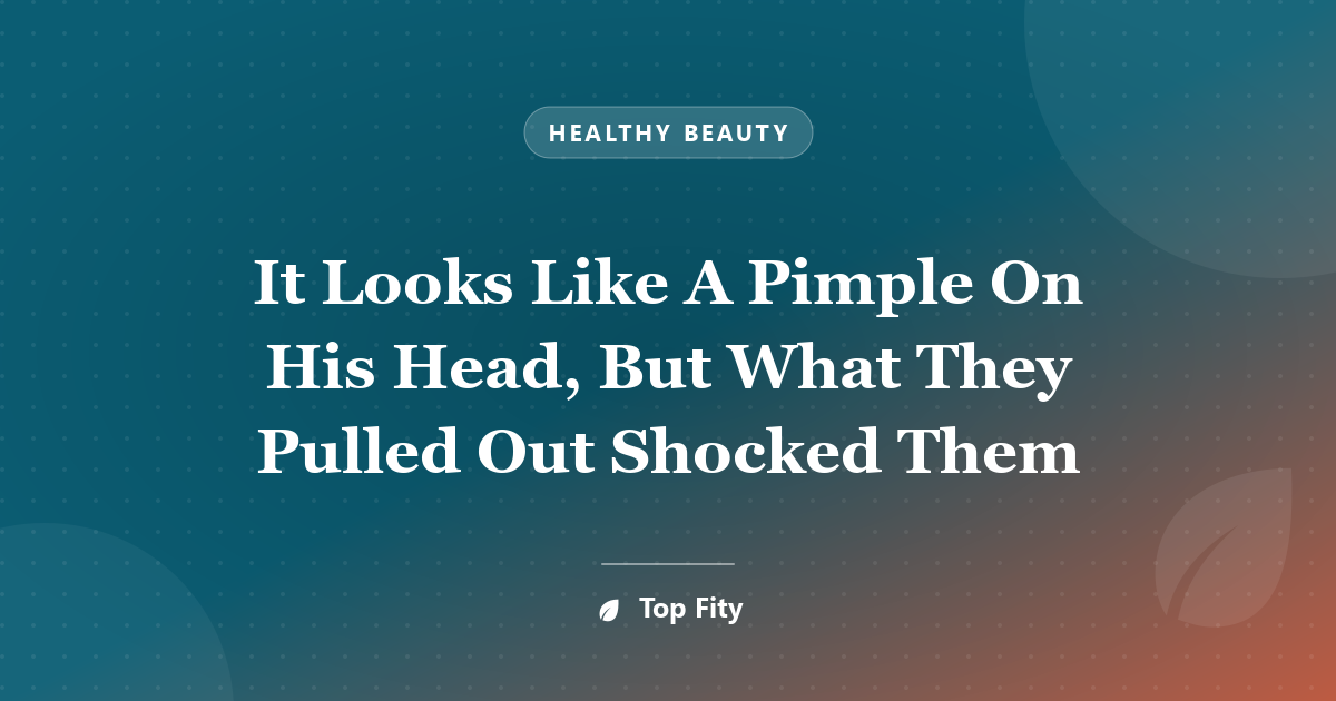 It Looks Like A Pimple On His Head, But What They Pulled Out Shocked Them